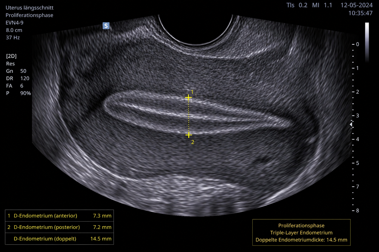 Messung der doppelten Endometriumdicke im Ultraschall, triple Line Endometrium